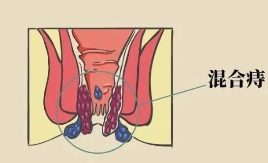 得了痔疮用什么办法解决最好最快:得了痔疮用什么办法解决最好最快?专业解析与分级应对方案 得了痔疮用什么办法解决最好最快:得了痔疮用什么办法解决最好最快?专业解析与分级应对方案