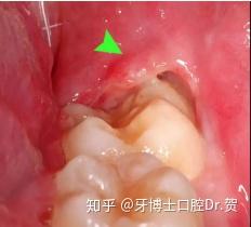 为什么尽量不要拔智齿:保留你的天然牙,为什么尽量不要拔智齿