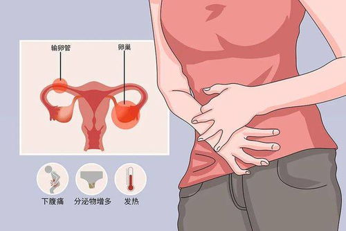 女性附件炎疼痛位置图:女性附件炎疼痛位置图,了解症状,及时就医是关键 女性附件炎疼痛位置图:女性附件炎疼痛位置图,了解症状,及时就医是关键