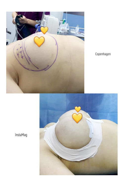 复合隆胸是什么意思:复合隆胸是什么意思?全面解析这项先进的隆胸技术