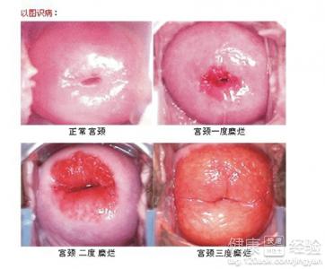 宫颈糜烂怎么才能彻底治好:宫颈糜烂怎么才能彻底治好?这些科学方法要知道 宫颈糜烂怎么才能彻底治好:宫颈糜烂怎么才能彻底治好?这些科学方法要知道
