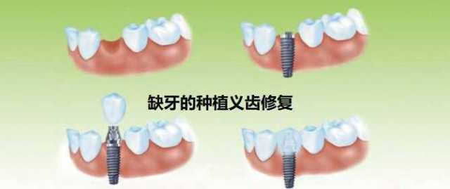 种牙的流程 需要去几次：种牙的流程全解析，需要去几次？