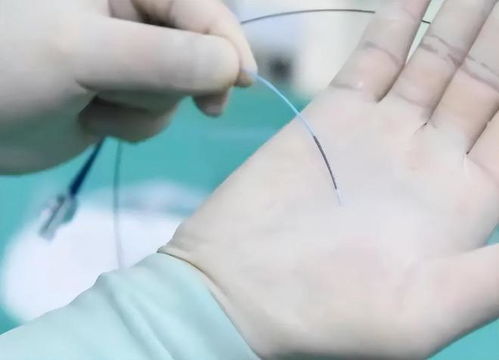 为什么得了肛瘘人就废了:为什么得了肛瘘人就废了?