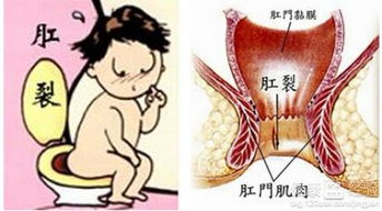 痔疮最怕一味中药:痔疮最怕一味中药!这招狠,3天见效!