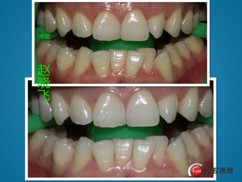 激光美白牙齿一次多少钱:激光美白牙齿一次多少钱?全面解析与避坑指南 激光美白牙齿一次多少钱:激光美白牙齿一次多少钱?全面解析与避坑指南