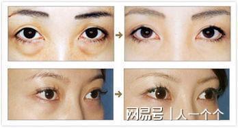 去眼袋手术要多久恢复正常:去眼袋手术要多久恢复正常? 去眼袋手术要多久恢复正常:去眼袋手术要多久恢复正常?