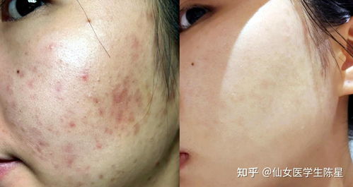 治疗痘印的最有效方法:治疗痘印的最有效方法,从根源修复到日常护理全解析 治疗痘印的最有效方法:治疗痘印的最有效方法,从根源修复到日常护理全解析