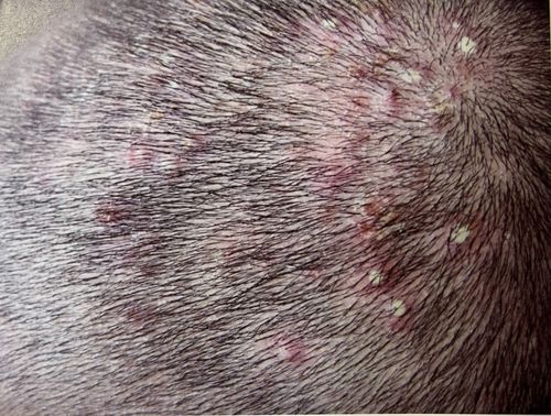 毛囊炎图片和症状图：认识毛囊炎，症状表现与图片解析