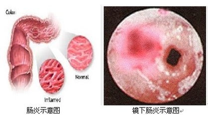 慢性结肠炎最佳药:慢性结肠炎最佳药,权威推荐与治疗策略解析 慢性结肠炎最佳药:慢性结肠炎最佳药,权威推荐与治疗策略解析