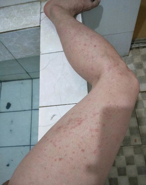 最轻的银屑病图片:最轻的银屑病长什么样?这些图片告诉你真相 最轻的银屑病图片:最轻的银屑病长什么样?这些图片告诉你真相