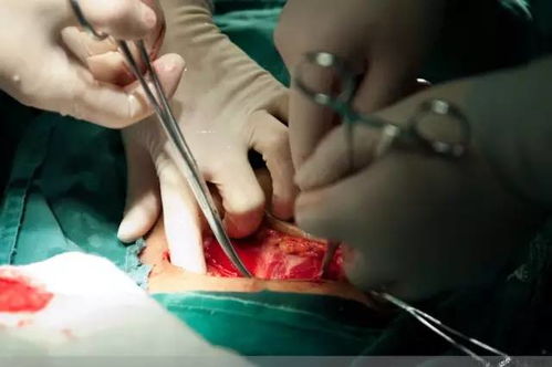割包切割手术视频真实:揭秘割包切割手术视频真实,你需要知道的真相 割包切割手术视频真实:揭秘割包切割手术视频真实,你需要知道的真相