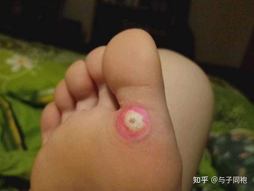 脚长鸡眼怎么治疗能根除:脚长鸡眼怎么治疗能根除,彻底摆脱困扰的实用指南 脚长鸡眼怎么治疗能根除:脚长鸡眼怎么治疗能根除,彻底摆脱困扰的实用指南