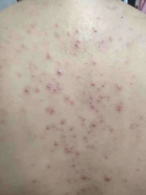 毛囊炎会自愈吗:毛囊炎会自愈吗?原因、症状与处理方法全解析 毛囊炎会自愈吗:毛囊炎会自愈吗?原因、症状与处理方法全解析