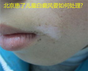 普通白斑图片:普通白斑图片对比,了解常见原因与早期白癜风的鉴别 普通白斑图片:普通白斑图片对比,了解常见原因与早期白癜风的鉴别