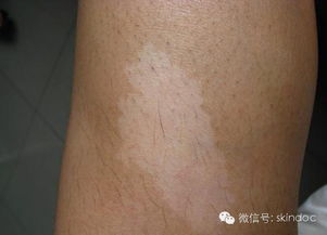 普通白斑图片:普通白斑图片对比,了解常见原因与早期白癜风的鉴别 普通白斑图片:普通白斑图片对比,了解常见原因与早期白癜风的鉴别