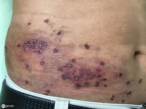 蛇缠腰:蛇缠腰,民间偏方还是科学真相? 蛇缠腰:蛇缠腰,民间偏方还是科学真相?