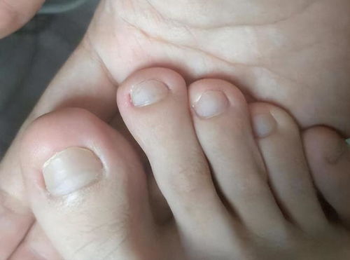 灰指甲是一碰就传染吗:灰指甲是一碰就传染吗?关于灰指甲的真相来了! 灰指甲是一碰就传染吗:灰指甲是一碰就传染吗?关于灰指甲的真相来了!