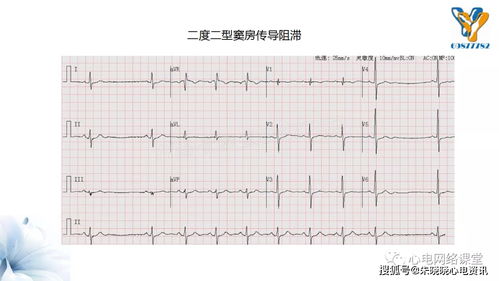 窦性心律什么意思:窦性心律,你的心脏在说什么?