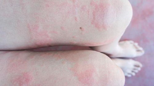 人工荨麻疹怎样才能治好:人工荨麻疹怎样才能治好?全面解析与科学应对策略