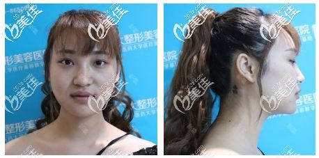 下颌骨十个做了九个后悔:下颌骨十个做了九个后悔?整容界血泪教训大公开!