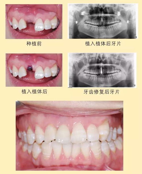 梦到自己牙齿掉了好多：梦到自己牙齿掉了好多，解密潜意识的恐惧与释然