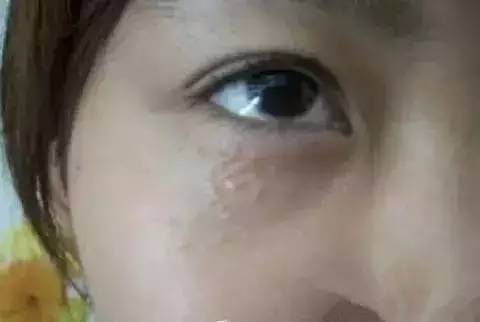 面部脂肪粒是什么原因引起的：面部脂肪粒，原因解析与预防指南