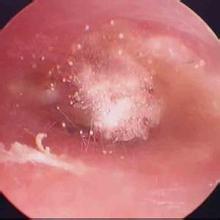 扁桃体炎偏方一天痊愈:扁桃体炎偏方一天痊愈?这些方法或许能帮你缓解不适! 扁桃体炎偏方一天痊愈:扁桃体炎偏方一天痊愈?这些方法或许能帮你缓解不适!