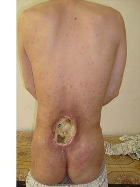 银屑病能治好吗:银屑病能治好吗?权威解答来了!