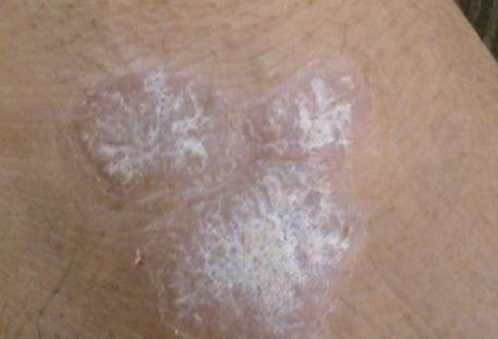 银屑病能治好吗:银屑病能治好吗?权威解答来了! 银屑病能治好吗:银屑病能治好吗?权威解答来了!