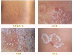 银屑病能治好吗:银屑病能治好吗?权威解答来了! 银屑病能治好吗:银屑病能治好吗?权威解答来了!