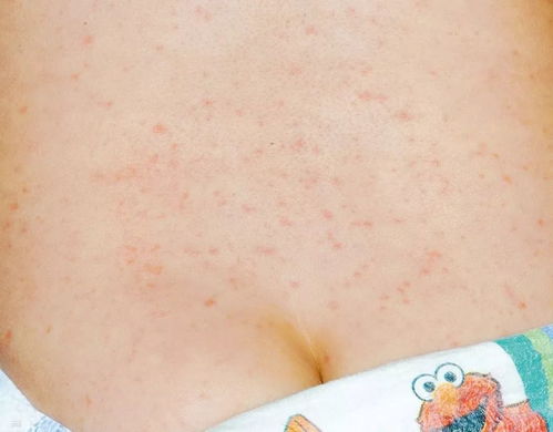 宝宝各类疹子识别图:宝宝出疹子怎么办?一看就懂的各类疹子识别图 宝宝各类疹子识别图:宝宝出疹子怎么办?一看就懂的各类疹子识别图