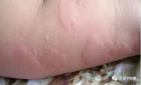 宝宝各类疹子识别图:宝宝出疹子怎么办?一看就懂的各类疹子识别图 宝宝各类疹子识别图:宝宝出疹子怎么办?一看就懂的各类疹子识别图