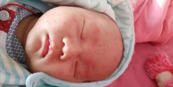 宝宝各类疹子识别图:宝宝出疹子怎么办?一看就懂的各类疹子识别图 宝宝各类疹子识别图:宝宝出疹子怎么办?一看就懂的各类疹子识别图