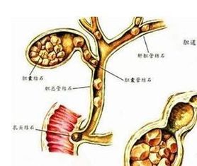 胆结石怎么治疗最有效最快:胆结石怎么治疗最有效最快?科学方案与个体化治疗解析