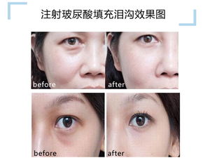 50岁有眼袋了怎么处理:50岁眼袋困扰?这些方法帮你重拾年轻神采
