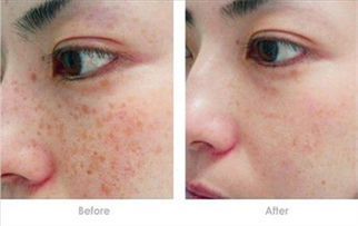 激光祛斑的危害与效果价格:激光祛斑,全面解析效果、价格与潜在风险 激光祛斑的危害与效果价格:激光祛斑,全面解析效果、价格与潜在风险