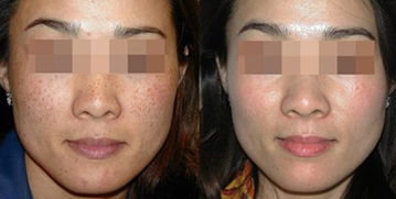 激光祛斑的危害与效果价格:激光祛斑,全面解析效果、价格与潜在风险 激光祛斑的危害与效果价格:激光祛斑,全面解析效果、价格与潜在风险