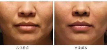 抬头纹太深了用什么方法能去掉:抬头纹太深了?这些方法或许能帮你抚平年龄焦虑 抬头纹太深了用什么方法能去掉:抬头纹太深了?这些方法或许能帮你抚平年龄焦虑