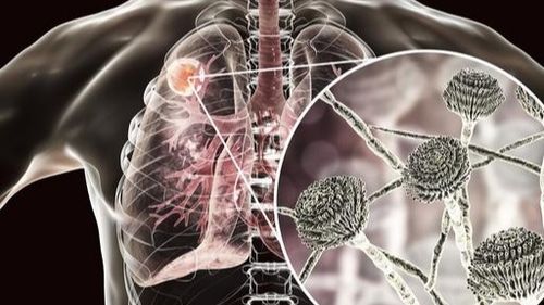 女子接触发霉玉米后肺部全白