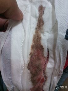 正常月经血块图片:月经中出现血块?了解正常与异常的区别