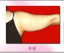 手臂抽脂后多久开始细:手臂抽脂后多久开始变细?详细解析恢复时间线