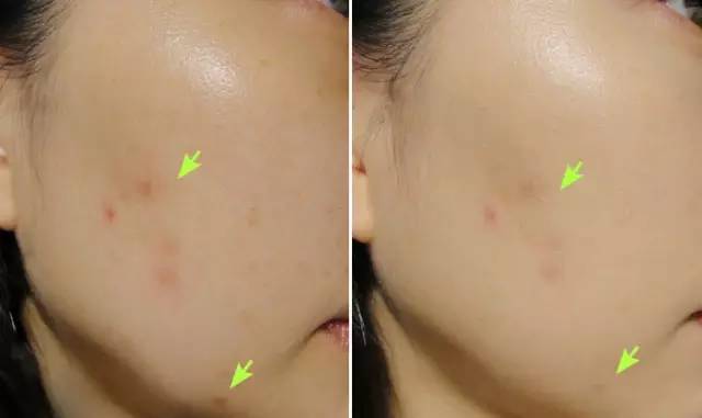 女性私护处长痘痘是什么原因:女性私密处长痘痘?这些原因你可能不知道 女性私护处长痘痘是什么原因:女性私密处长痘痘?这些原因你可能不知道