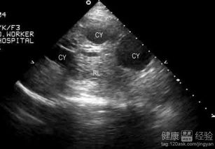 肝囊肿是什么病:肝囊肿是什么病?这些你必须知道的要点 肝囊肿是什么病:肝囊肿是什么病?这些你必须知道的要点