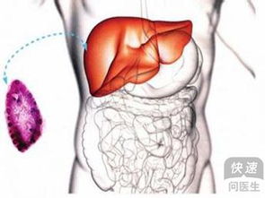 肝囊肿是什么病:肝囊肿是什么病?这些你必须知道的要点