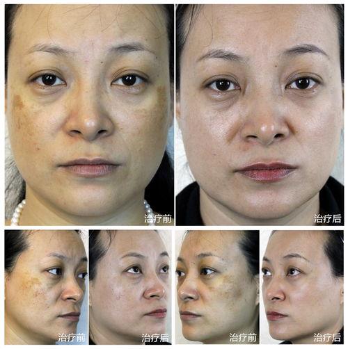 黄褐斑怎么才能去掉:黄褐斑怎么才能去掉?这些科学方法值得一试! 黄褐斑怎么才能去掉:黄褐斑怎么才能去掉?这些科学方法值得一试!