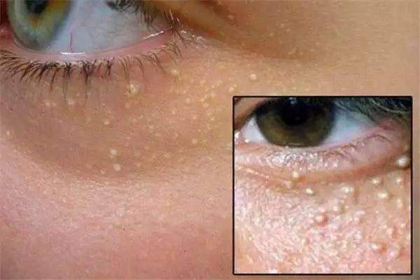 脂肪粒怎么去除小妙招：告别恼人脂肪粒！这些简单小妙招让你的皮肤更光滑（终极指南）