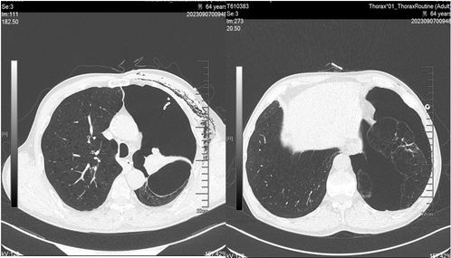 间质性肺炎能治愈吗:间质性肺炎,治愈的希望与现实挑战