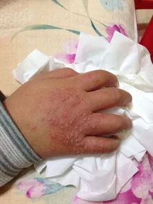 黑便是什么病的前兆:黑便,警惕身体发出的疾病警报