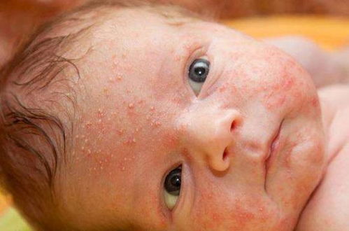 痤疮和痘痘的区别图片:痤疮和痘痘,傻傻分不清?一文彻底搞懂它们的区别!