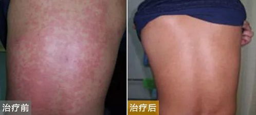 慢性荨麻疹打两针好了:两针疗法显奇效,慢性荨麻疹困扰终得解